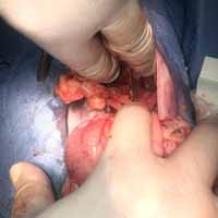 Dil Damak Diyafram Yırtığı Operasyonu 7