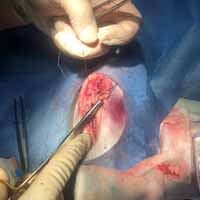 Dil Damak Diyafram Yırtığı Operasyonu 8