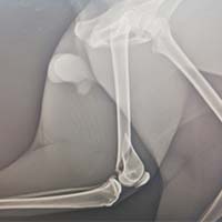 Femur Kırığı Operasyonu 3