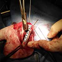 Femur Kırığı Operasyonu 6