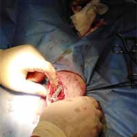 Femur Kırığı Operasyonu 7