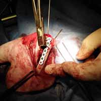 Femur Kırığı Operasyonu 8