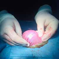 Gastrik Dilatasyon Operasyonu 2