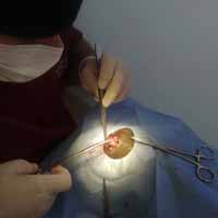 Meme Tümörü Operasyonu 6