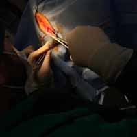 Perineal Üretrostomi 3