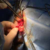 Perineal Üretrostomi 4