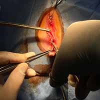 Perineal Üretrostomi 5