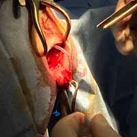 Perineal Üretrostomi 6