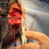 Perineal Üretrostomi 7