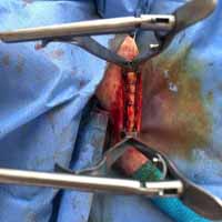 Tibia Kırığı Operasyonu 11