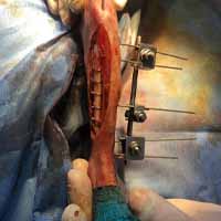 Tibia Kırığı Operasyonu 14