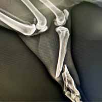 Tibia Kırığı Operasyonu 15