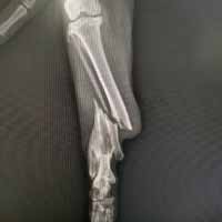 Tibia Kırığı Operasyonu 16