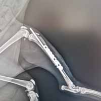 Tibia Kırığı Operasyonu 2