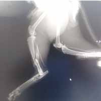 Tibia Kırığı Operasyonu 3