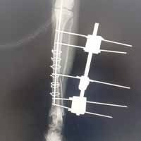 Tibia Kırığı Operasyonu 5