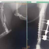 Tibia Kırığı Operasyonu 6